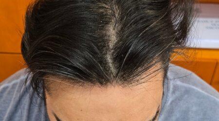 2.-After-4500-Grafts-top
